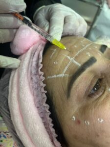 botox-1